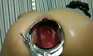 πρόπτωση speculum με ...